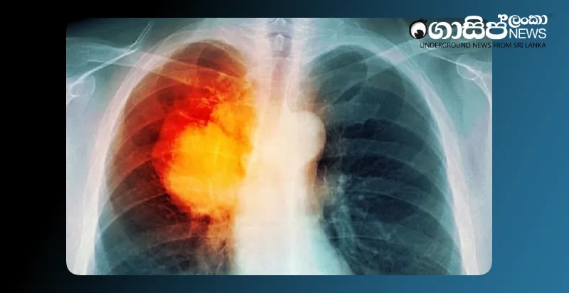 lung-cancer-rates-rise-among-non-smoking-women-in-asia