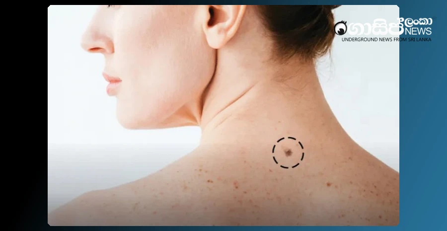 the-skin-cancer-cure-vaccine-introduced-by-moderna-shows-successful-results