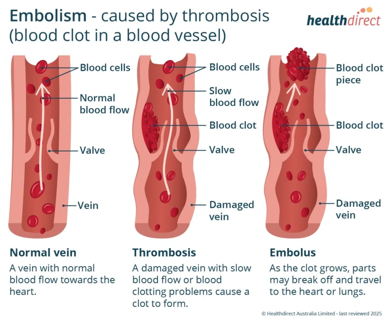 after-the-death-of-the-hollywood-actress-special-attention-was-paid-to-the-blood-clot-in-the-lungs