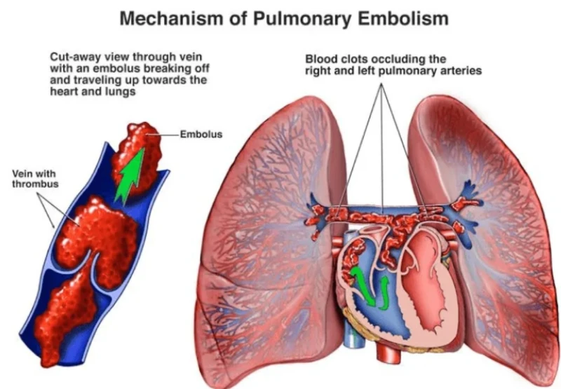 after-the-death-of-the-hollywood-actress-special-attention-was-paid-to-the-blood-clot-in-the-lungs