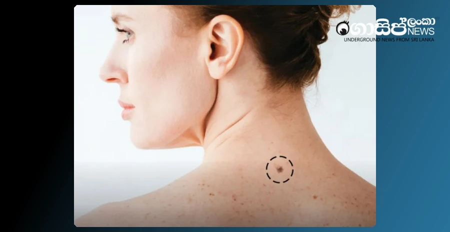 a-rare-skin-cancer-is-spreading-in-britain