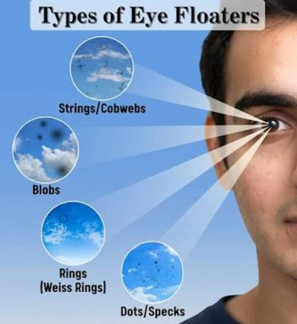 see-a-doctor-if-you-see-floating-spots-in-front-of-the-eyes
