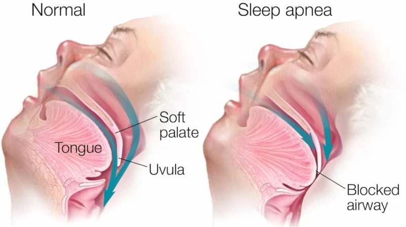 what-is-sleep-apnea-that-rakita-also-has