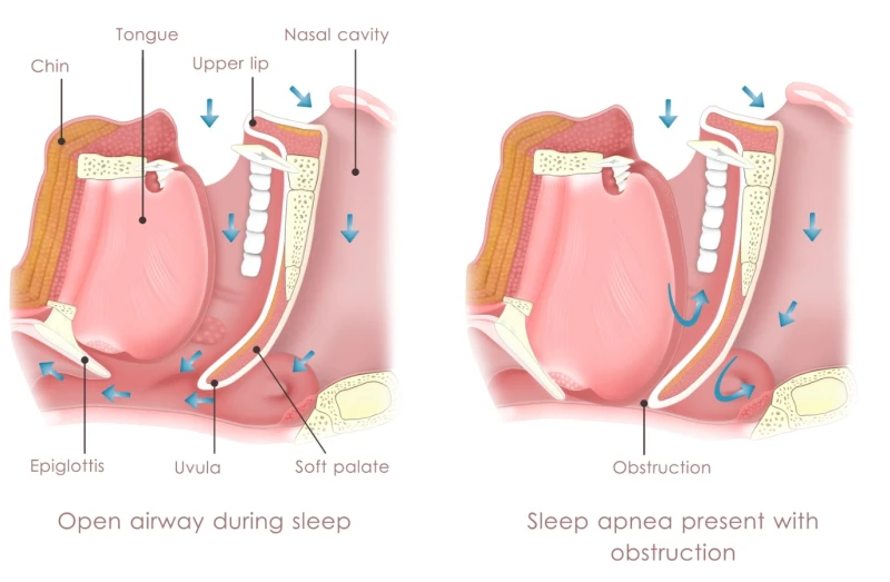 what-is-sleep-apnea-that-rakita-also-has