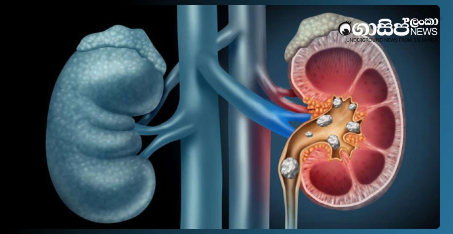 more-than-five-thousand-people-are-on-waiting-lists-for-kidney-stone-removal-surgery