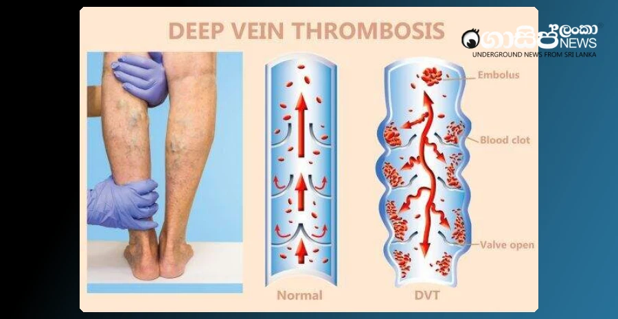 prolonged-sitting-increases-deadly-deep-vein-thrombosis-among-young-adults