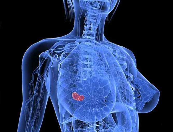 recent-research-reveals-many-insights-into-ways-to-prevent-breast-cancer